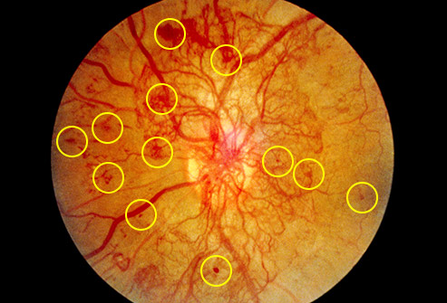 8.	رتینوپاتی دیابتی