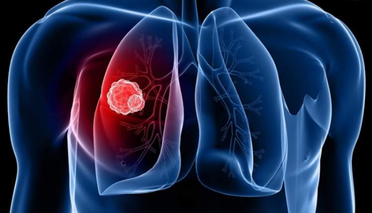 جان باختن بیش از ۹ میلیون نفر بر اثر سرطان در سال جاری