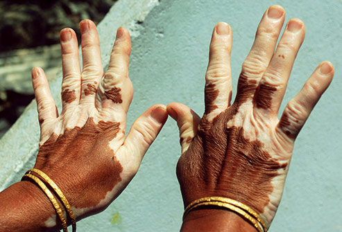 رنگ چشم ها و ویتیلیگو* Vitiligo