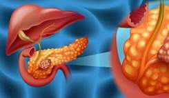 سرطان لوزالمعده مرگبارترین سرطان جهان است