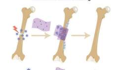 ساخت بانداژ جدید برای ترمیم سریع‌تر استخوان