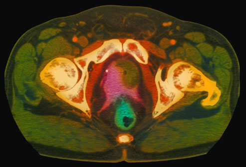 تصویر برداری از سرطان پروستات