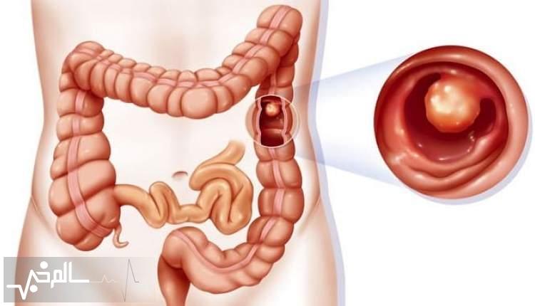 آنتی بیوتیک ها ابتلا به بیماری التهابی روده را افزایش می‌دهد