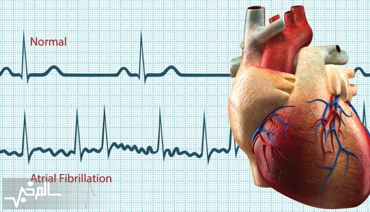 کووید ۱۹ باعث بروز فیبریلاسیون دهلیزی در برخی بیماران می شود