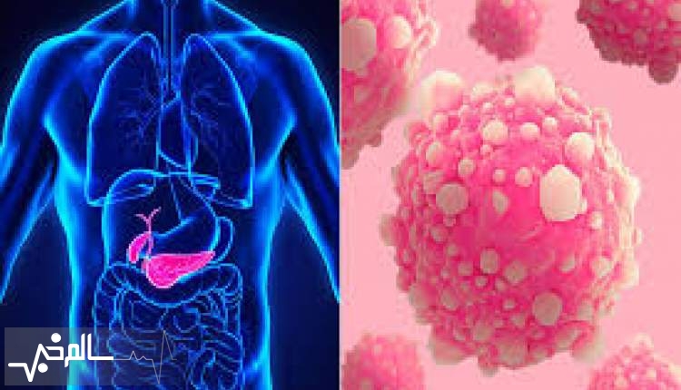 توسعه ایمپلنت دارورسان برای درمان سرطان خاموش پانکراس