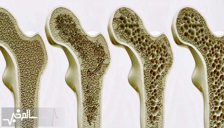 آغاز غربالگری پوکی استخوان زنان بالای ۵۰ سال