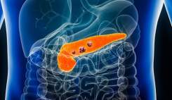 تست خون جدید با دقت 85 درصد سرطان پانکراس را در مراحل اولیه شناسایی می‌کند